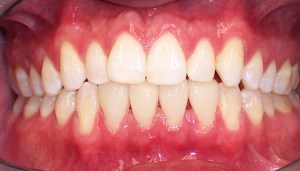 After photo: Porcelain veneers on lower front teeth create an even smile