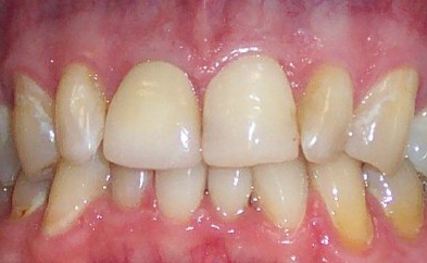 After photo: Upper front tooth repaired with all-ceramic dental crown