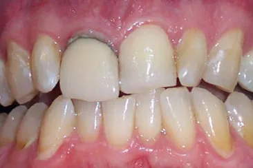 Before photo: Upper front tooth with grey line.