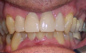 After photo: Upper front teeth, evenly sized and whiter, using all-ceramic dental crowns