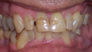 Before photo: Discolored and extremely worn upper front teeth