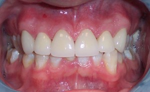 After photo: Upper front teeth evenly sized and brighter using all-ceramic dental crowns