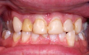 Before photo: Discolored front teeth with uneven sizing.