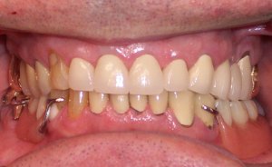 After photo: Upper front teeth, brighter and evenly sized, using all-ceramic dental crowns