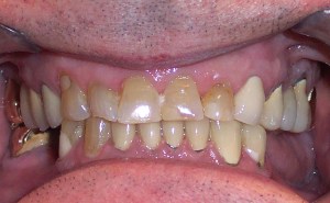 Before photo: Extremely worn and discolored front teeth