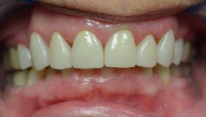 After photo: Evenly sized, brighter upper front teeth with all-ceramic dental crowns