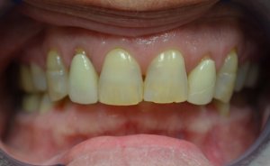 Before photo: Discolored & damaged front upper teeth