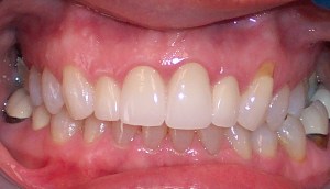 After photo: Upper front teeth, evenly placed and whiter with all-ceramic dental crowns