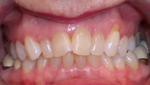Before photo: Crooked and discolored upper front teeth