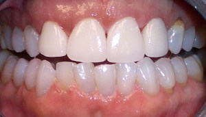 After photo: Upper front teeth, evenly sized and whiter with all-ceramic dental crowns