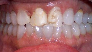 Before photo: Damaged and discolored upper front teeth