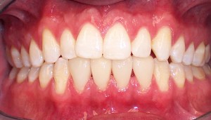 After photo: Lower front teeth, evenly sized and spaced with porcelain veneers