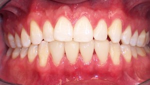 After photo: Lower front teeth, evenly sized and spaced with porcelain veneers