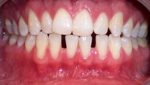 Before photo: Lower front teeth with gaps between teeth