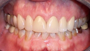 After photo: Upper front teeth, evenly sized and color matching with all-ceramic dental crowns