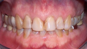 Before photo: Damaged and discolored teeth in the upper jaw