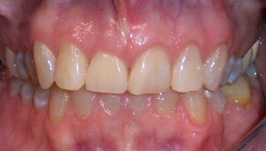 After photo: All-ceramic dental crown creates a more even, brighter smile