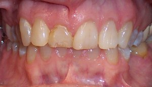 Before photo: Extremely damaged and discolored tooth in the upper jaw