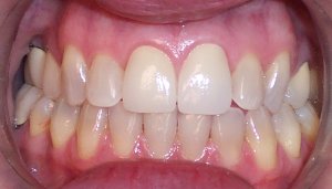 After photo: All-ceramic dental crowns create a more even, brighter smile