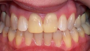 Before photo: Discolored upper front teeth