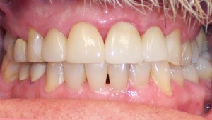 After photo: All-ceramic dental crowns and implant create an even, brighter smile