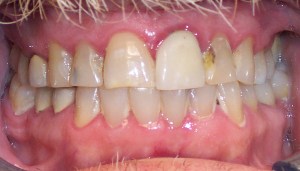 Before photo: Uneven smile with dental implant surrounded by damaged upper teeth