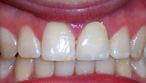 After photo: Upper front teeth looking natural with an all-ceramic dental crown