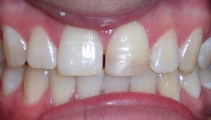 Before photo: Upper front tooth with discoloration and gap