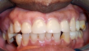 After photo: All-ceramic dental crowns create an even, bright smile