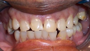 Before photo: Mis-sized and gappy upper teeth