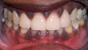 After photo: All-ceramic dental crowns create an even, brighter smile