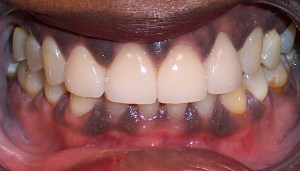 After photo: All-ceramic dental crowns create an even, brighter smile