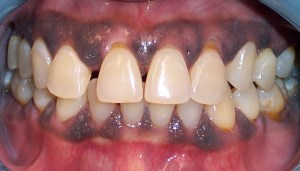 Before photo: Gappy upper front teeth