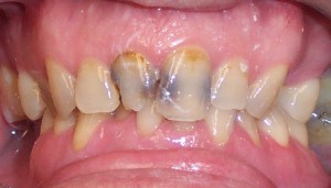 Before photo: Chipped and severely decaying upper front teeth