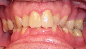 After photo: All-ceramic dental crowns create an even, healthier smile
