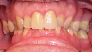 After photo: All-ceramic dental crowns create an even, healthier smile