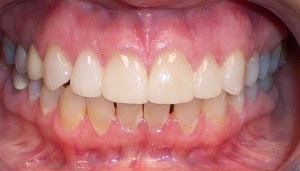 After photo: Porcelain veneers on upper front teeth create an even smile