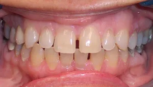 Before photo: Gappy and worn upper front teeth