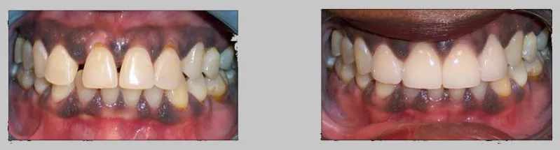 Before and After Photos: All Ceramic Crowns case study, upper gaps fixed