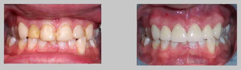 Before and After Photos: All Ceramic Crowns case study, discolored mis-shaped teeth fixed