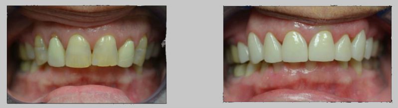 Before and After Photos: All Ceramic Crowns case study, discolored front teeth fixed