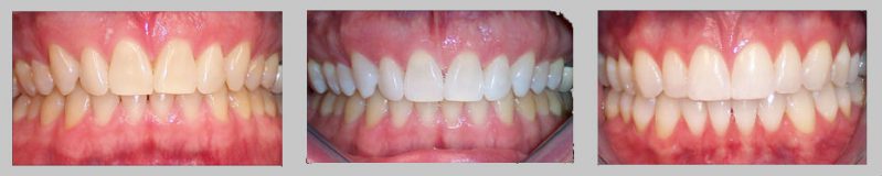 Three Photos: Teeth Whitening case study