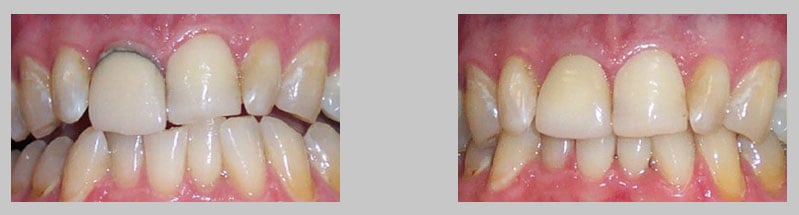 Before and After Photos: All Ceramic Crowns case study, upper from teeth